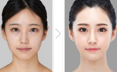 女性整形,重塑自信，焕发美丽风采