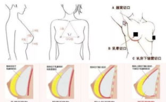 胸部整形一般多少钱,价格因素与预算规划