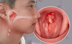 鼻咽癌是怎么引起的,病因、预防与治疗策略