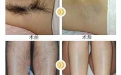 整形医院脱毛,技术、效果与价格全解析